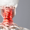 Whiplash Injuries Cervical Facet Joints