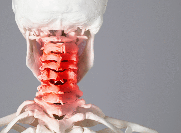 Whiplash Injuries Cervical Facet Joints